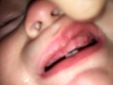 Вылезли 3 верхних зуба,