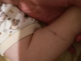 Сделали манту,через несколько часов