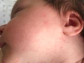 Аллергия или потничка?