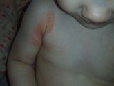 Help(( аллергия малыша