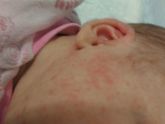 Цветение или аллергия?