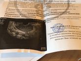 Гиперплазии эндометрия у кого было? Забеременели ли?