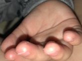 Облезают пальцы