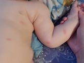 Алергия или комариный укус?