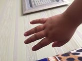 Отеки