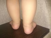 Вальгус стоп