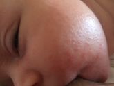 Акне