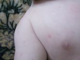 Аллергия?