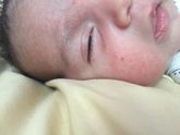 Аллергия или потничка