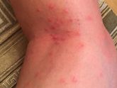 Заморские комары Аллергия что делать