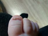 Слоится ноготь на ноге у ребенка