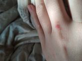 Сыпь. Внезапно
