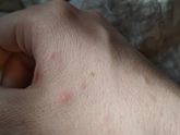 Сыпь. Внезапно