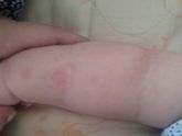 Аллергия на укус комара