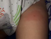 Покраснение от прививки