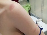 Алергия на АнвиМакс