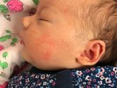 Аллергия или Цветение?
