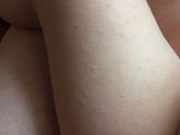 Чем помазать?