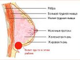 Застудила грудь