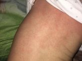 Аллергия?