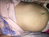 Высокая температура и сыпь на второй день болезни