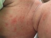 Потница??
