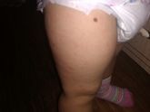 Такая сыпь по ногам