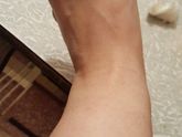 Отеки