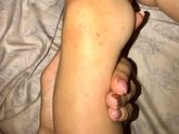 Ветрянка? Корь? Или аллергия?