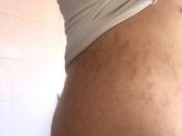 Растяжки на теле как бороться с ними ?