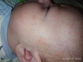 Аллергия или нет???