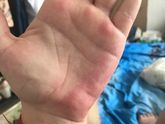 Изменения кожного покрова