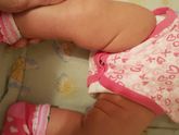 складочки на ножках не симметричны — 35 ответов | форум Babyblog