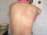 Сильный зуд и сыпь (похожа на крапивницу по фоткам инете)