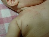 Аллергия или что?
