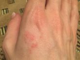 Что делать, аллергия на руке...