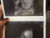 Узи 24,4 недели, двойняшки👶🏻👶🏻❤️