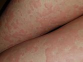 Кожная аллергия: хроническая крапивница и как мне помогла гомеопатия