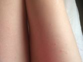 Сильный зуд и сыпь (похожа на крапивницу по фоткам инете)