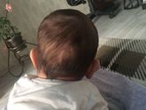 Деформация головы