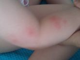 отдых в Греции. пятна у ребенка. sos! :(