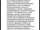Кесарево или естественные роды