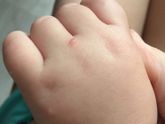 Что за болячка? С жидкостью внутри