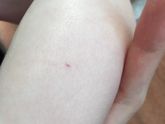 У ребёнка пятнышко на ноге