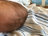 Гематома после родов