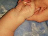 Аллергия или потница?