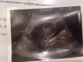 Повторное УЗИ