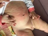 И снова тема про алергию.. замучалась