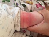 Покраснение на складках
