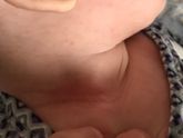 Утром Встали такое покраснение